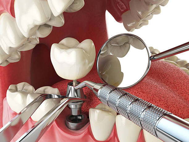 Best Emergency Dental Care for Abscessed Tooth in Pleasant Hill, MS